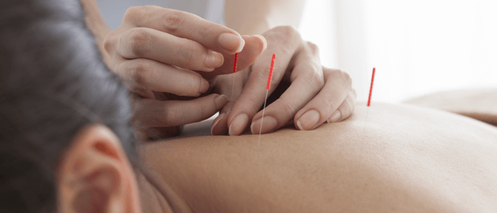 All that one should be knowing about acupuncture treatment
