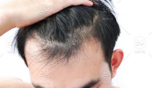 Learning the After Hair Transplant in Hair Treatment Surgery