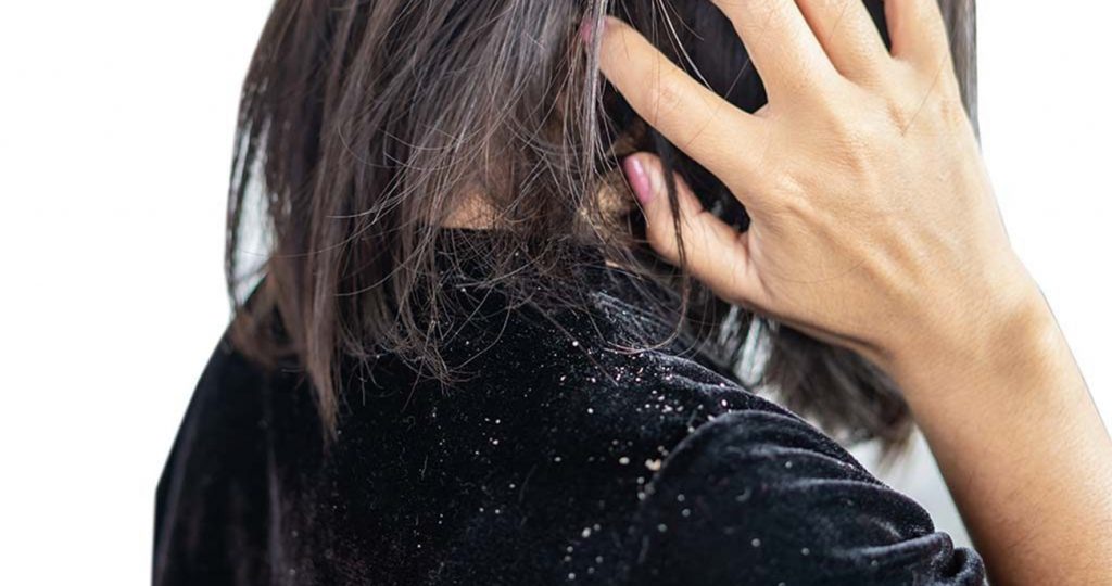 Check out Two Herbs for the best dandruff treatment in Singapore.